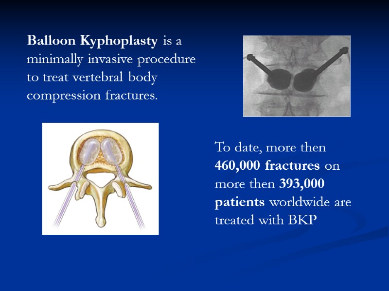 Balloon Kyphoplasty is a minimally invasive procedure to treat vertebral body compression fractures. 